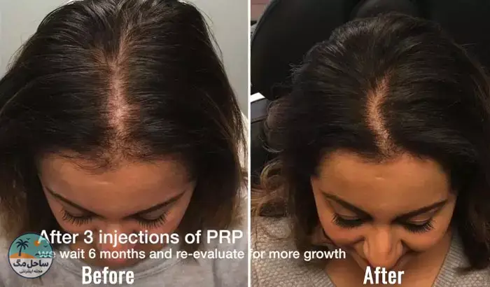 روش PRP برای ریزش مو