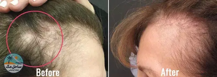 تاثیر درمان PRP برای ریزش مو