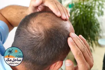 عوارض کاشت مو؛ 10 مشکل رایج و راهکارهای پیشگیری